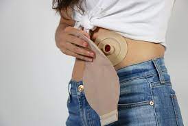 Ostomía