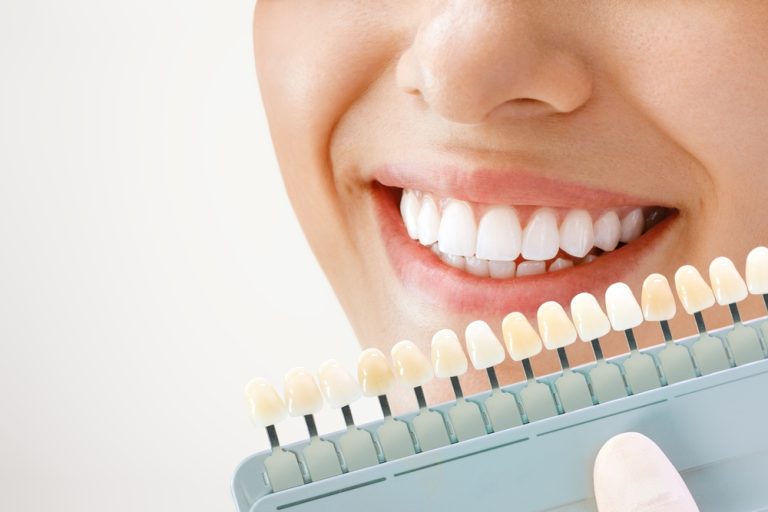Blanqueamiento Dental